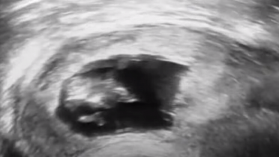 Beba, Ultrazvuk