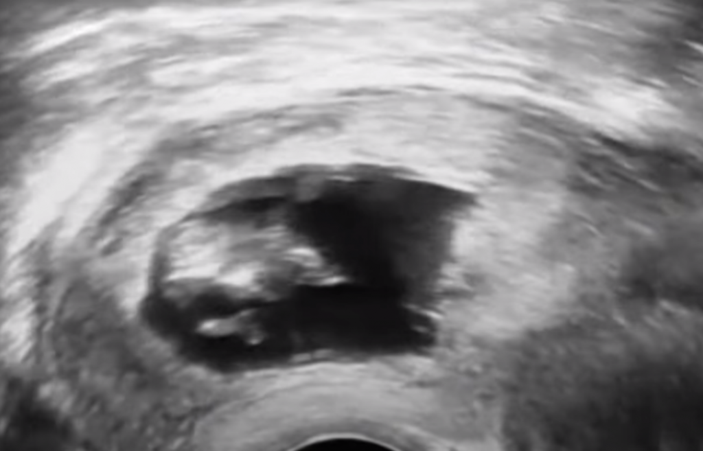 Beba, Ultrazvuk