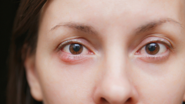 SVRAB, NELAGODNOST, CRVENILO: Kako nastaje i kako se leči čmičak na oku?