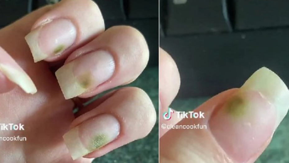 ŽENE BUDITE OPREZNE Devojka podelila kako izgleda kada nokti postanu žrtvom lošeg manikira