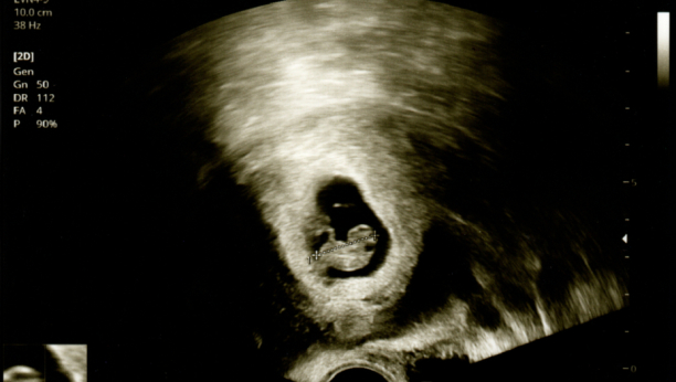 ODAO JE JEDAN DETALJ Momak otišao sa trudnom devojkom na ultrazvuk i shvatio da DETE NIJE NJEGOVO