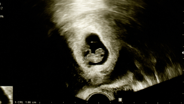 TO MU JE NAJGORI DAN U ŽIVOTU Muškarac otišao na ultrazvuk sa trudnom devojkom, pa saznao FRAPANTNU ISTINU