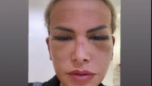 Ermina nakon operacije lica