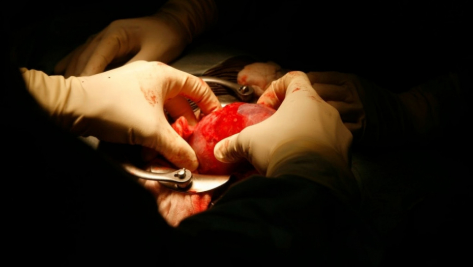 Bubreg, operacija, transplatacija